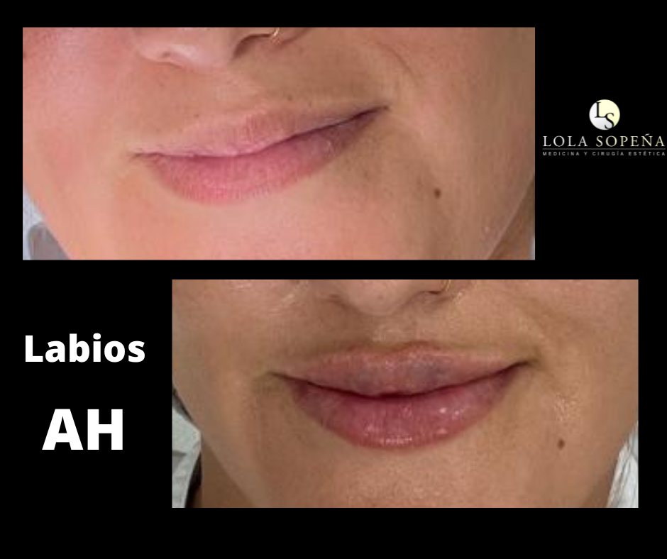 Aumento de labios