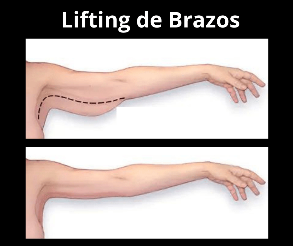 Lifting de brazos