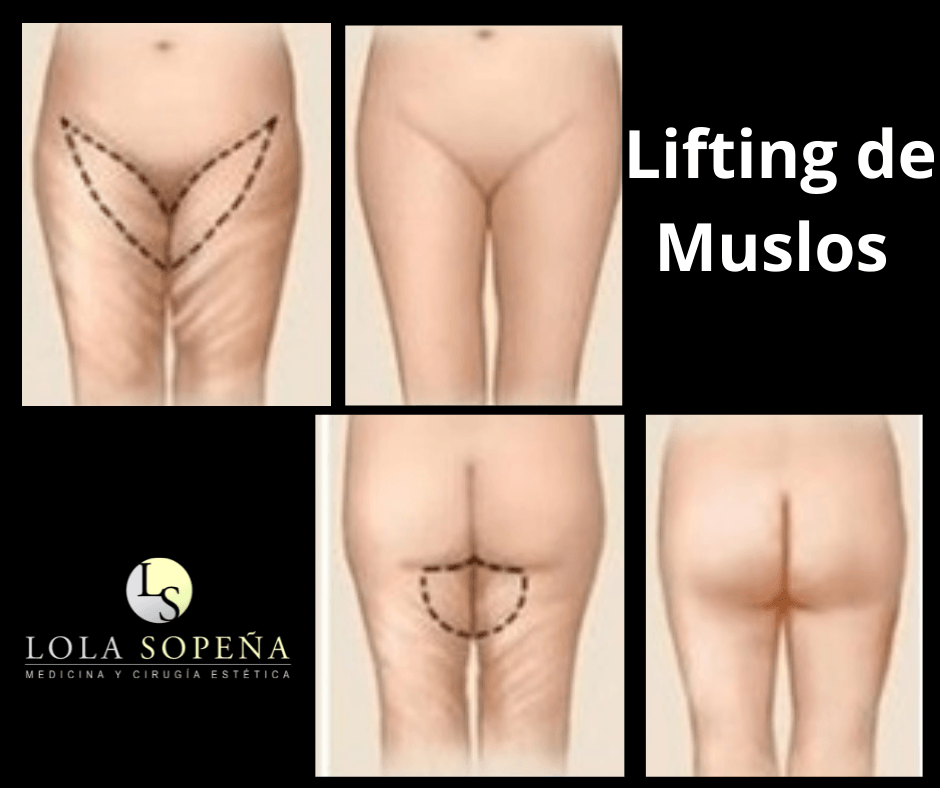 Lifting de Muslos