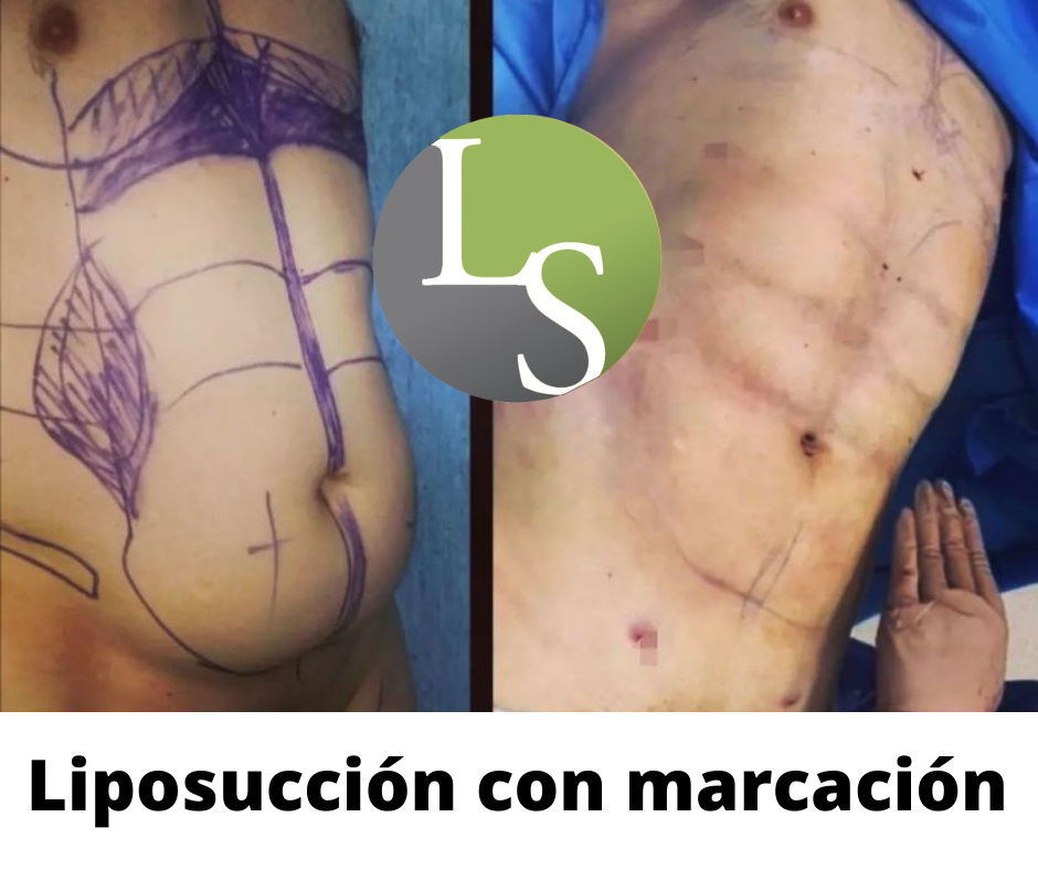 MARCACION ABDOMINAL