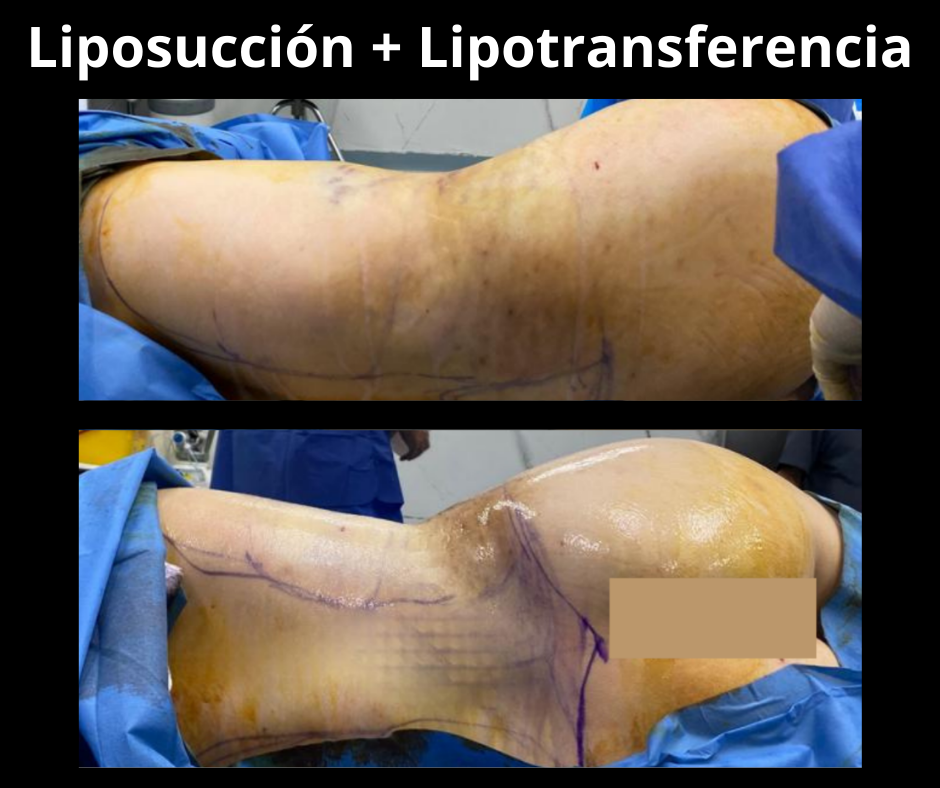 Liposuccion y Lipotransferencia