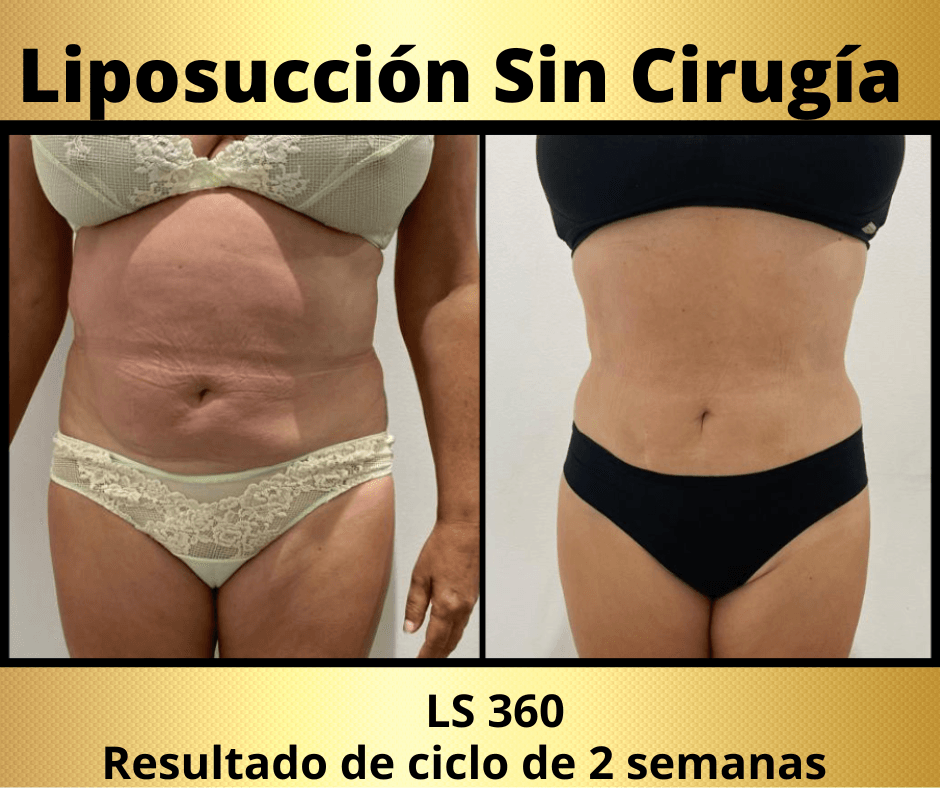 Liposuccion sin cirugia