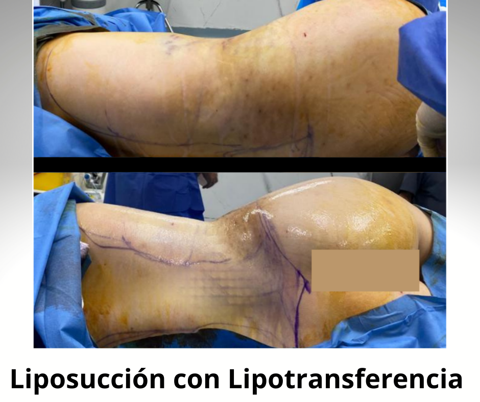 Liposucción con Lipotransferencia