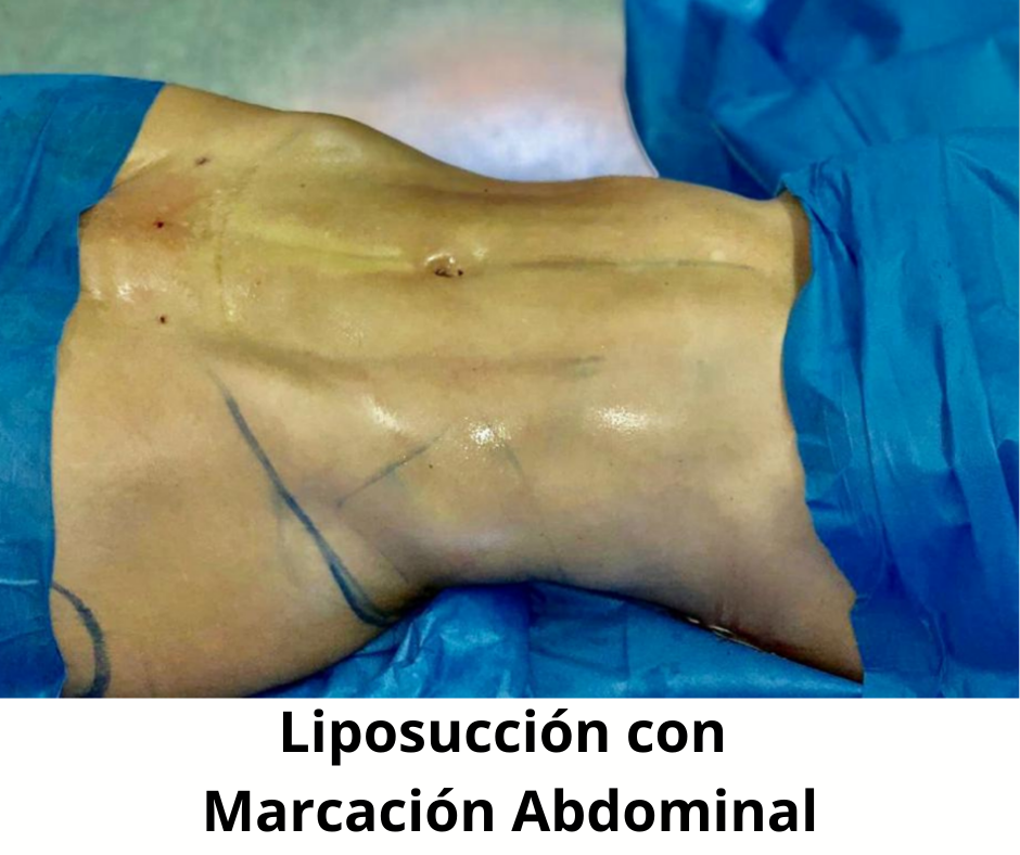 Liposucción con marcación abdominal