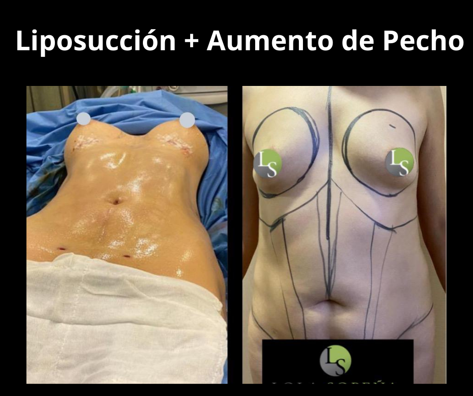 Liposuccion y Aumento de pecho