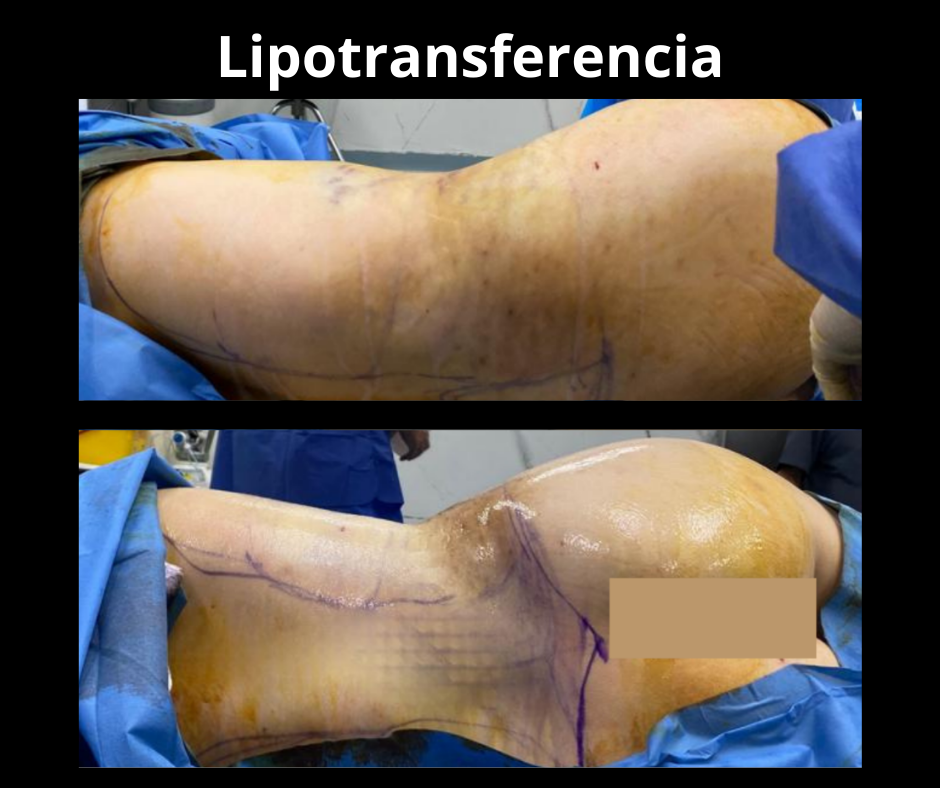 Lipotransferencia