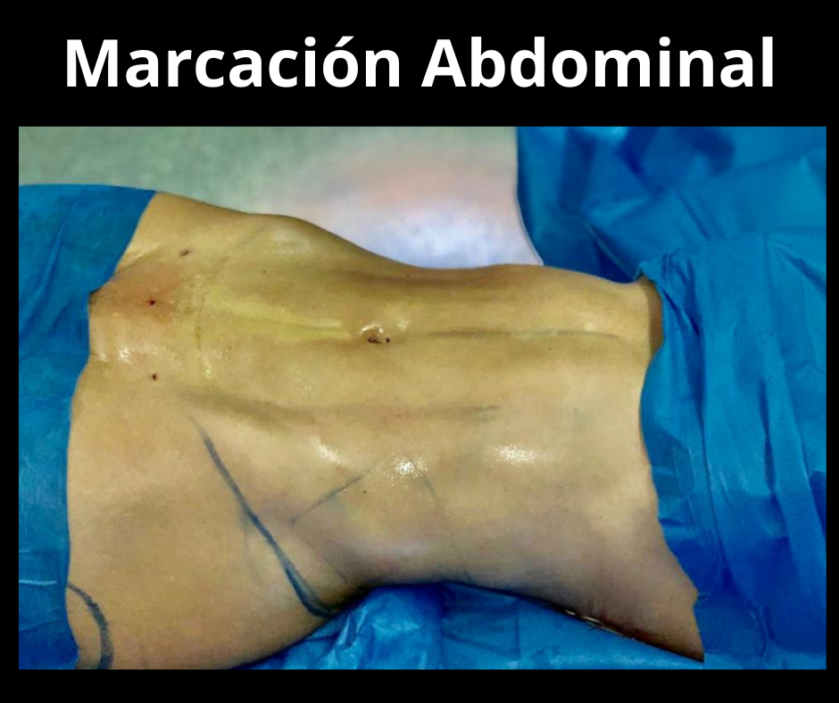 Marcacion abdominal