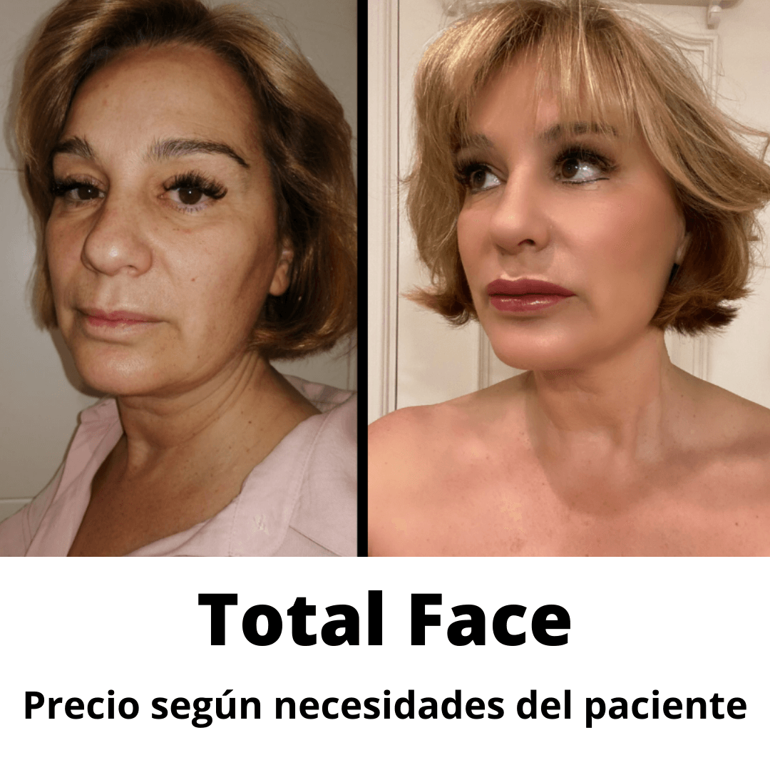 Rejuvenecimiento facaial completo precio