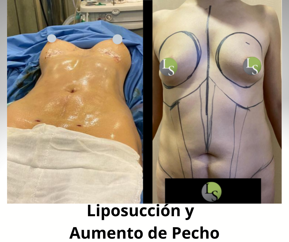 Liposucción  y aumento de pecho