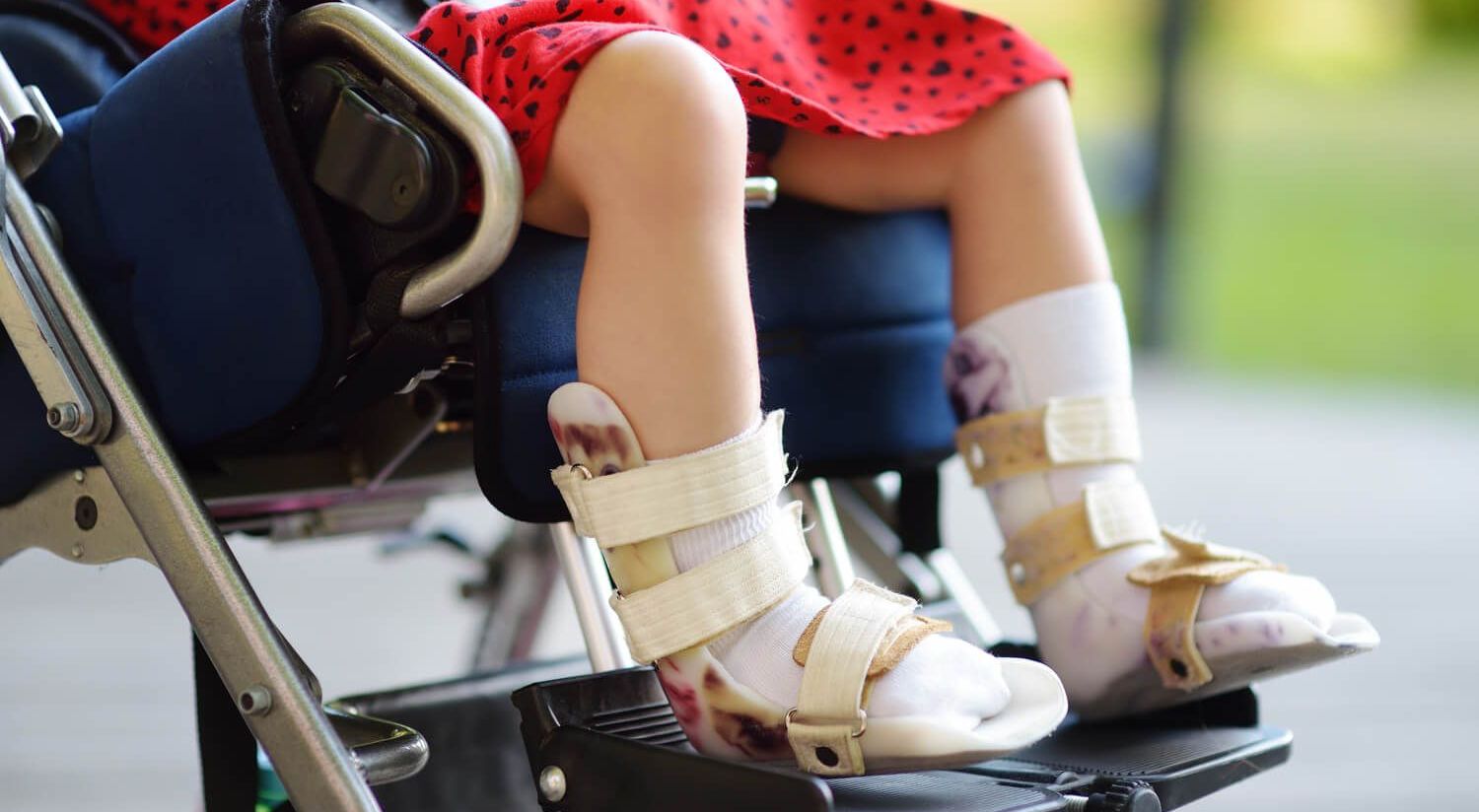 Foto von geschienten Füßen eines kleinen Kindes  in einem Rollstuhl