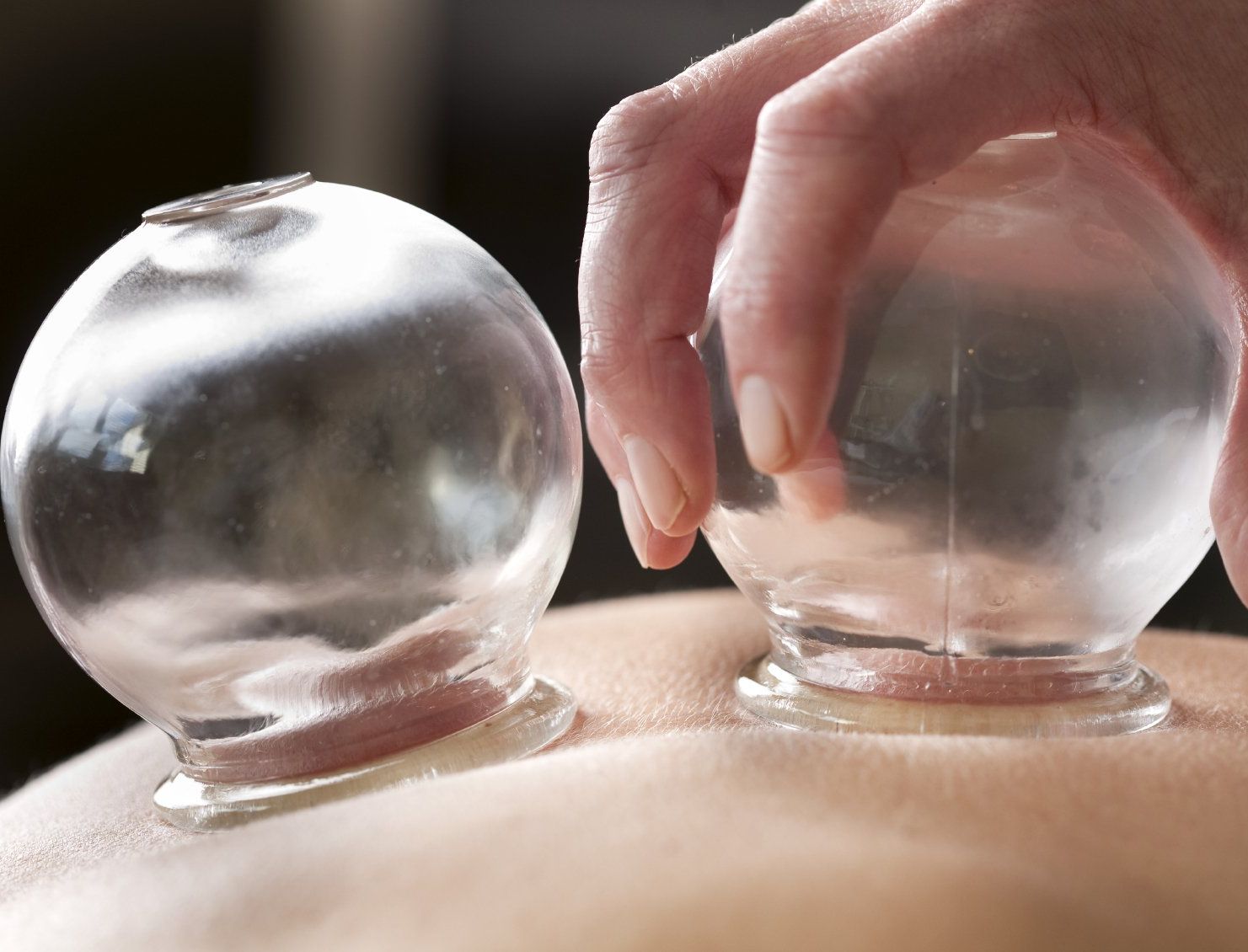 Schröpfen Schröpfen