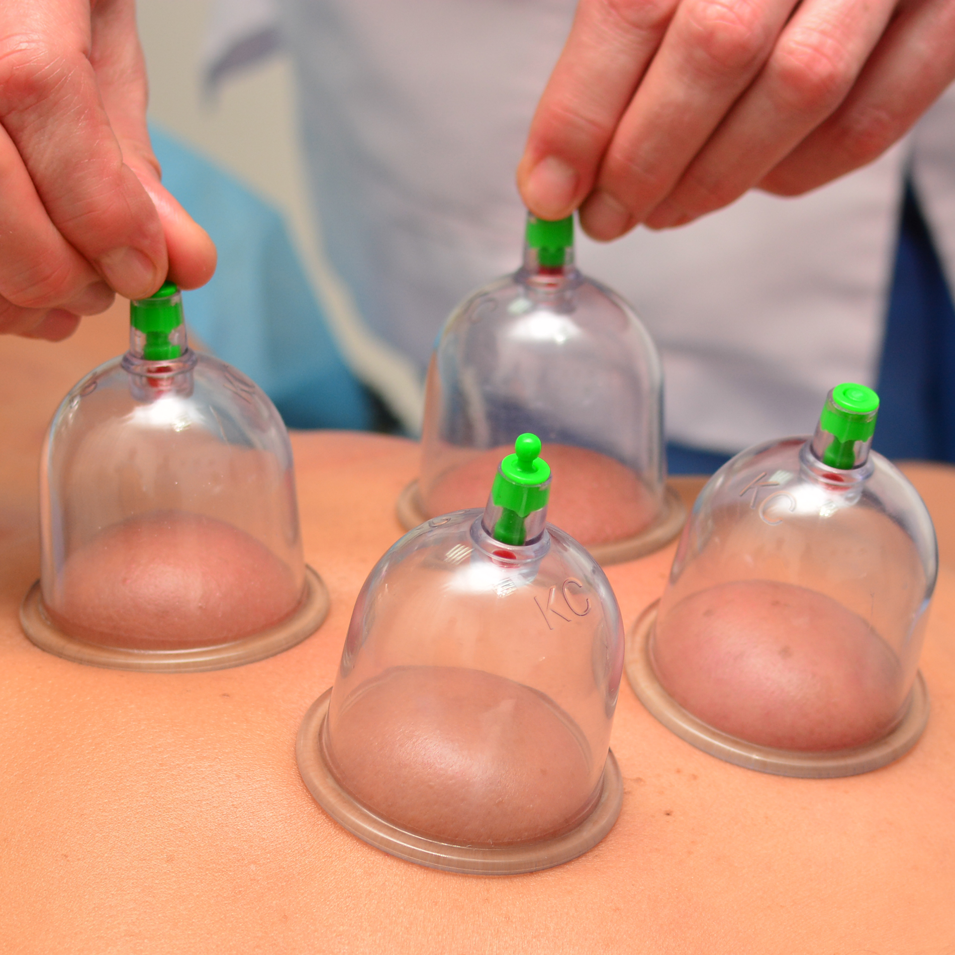Dry Cupping Therapy
