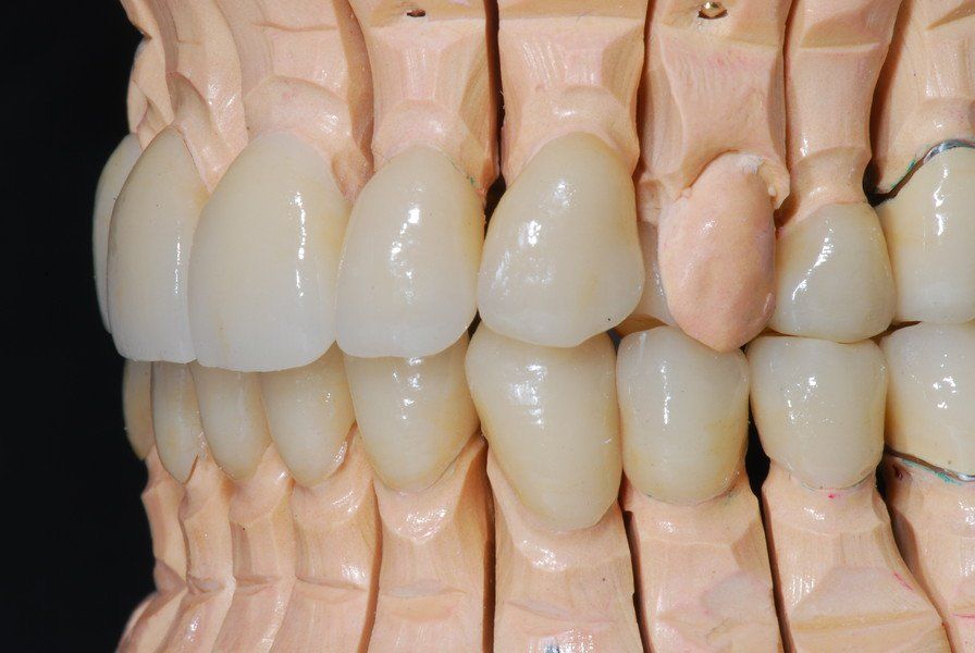 E-Max Press Veneers und Kronen Reicherzer Keramik Zirkon E-Max Press