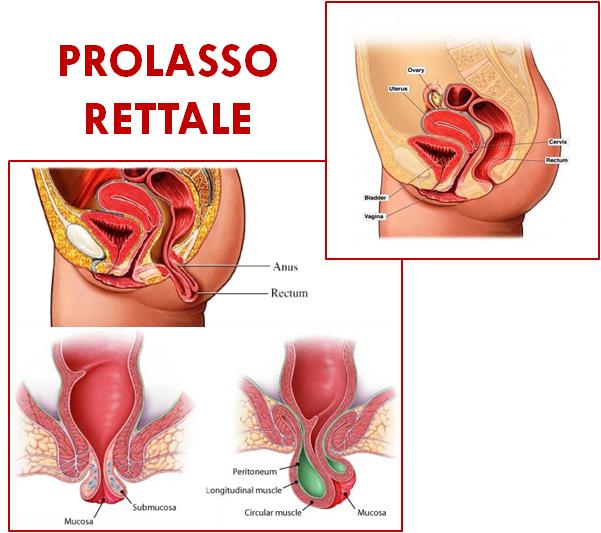 prolasso rettale