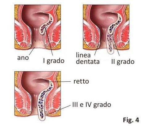 malattia emorroidaria - emorroidi - prolasso emorroidario - prolasso muco emorroidario - trombosi emorroidaria - varicosi emorroidaria - sanguinolento retto - sanguinolento ano - dolore ano - prurito ano