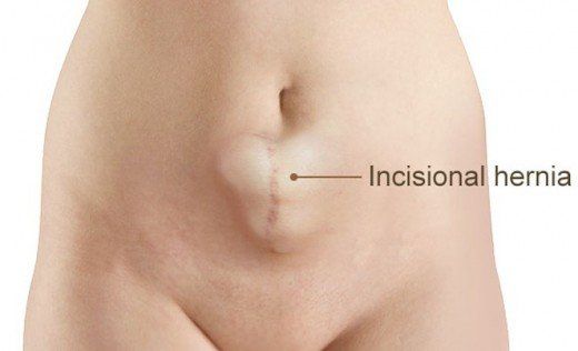 Riparazione laparocele