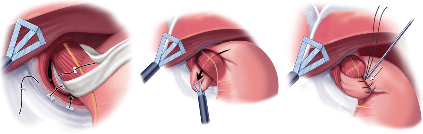 prolassectomia con stapler - chirurgia emorroidi - tecnica di Longo - resezione prolasso emorroidario