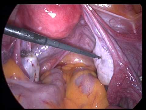 chirurgia ginecologica