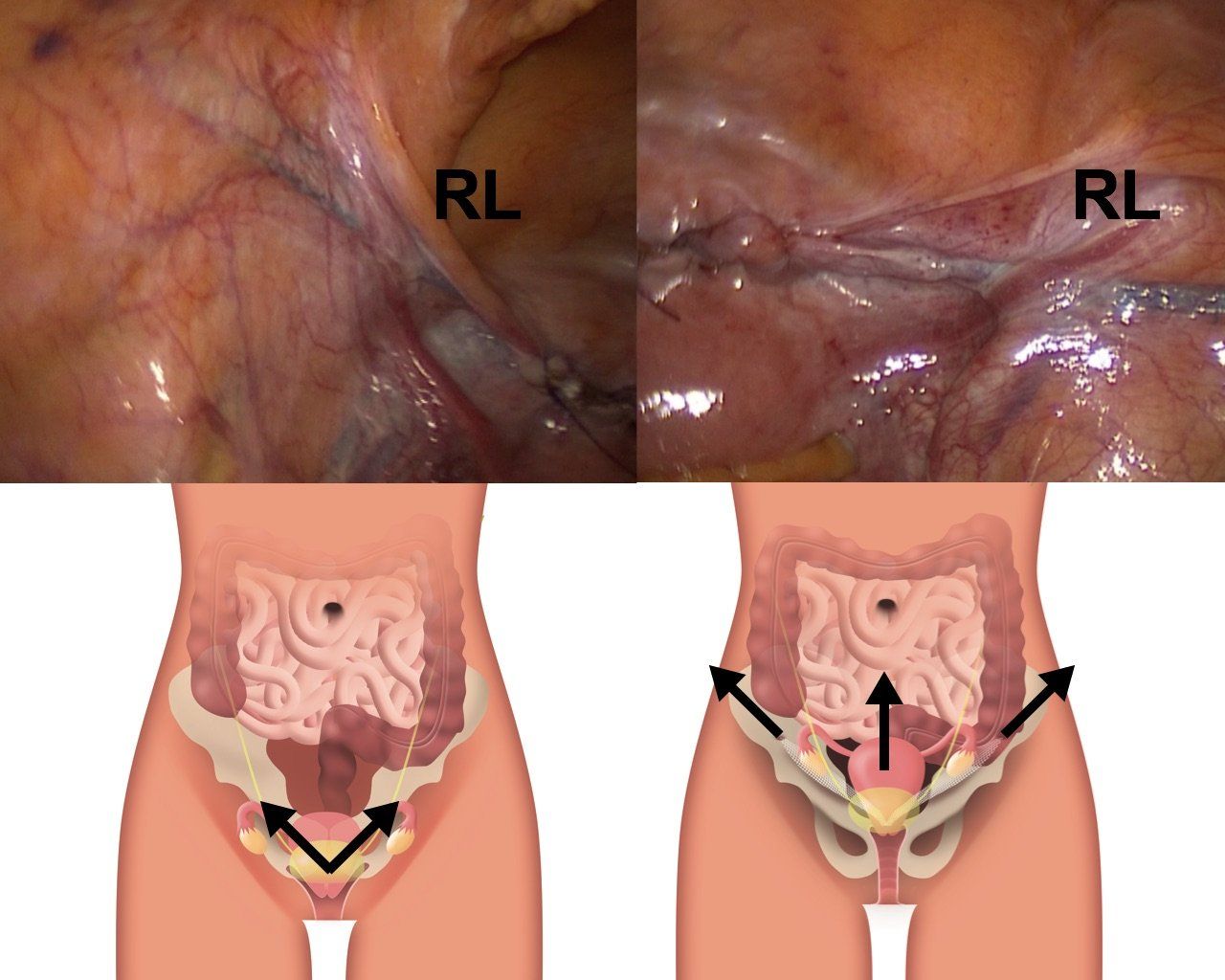 Sospensione degli organi pelvici laparoscopica