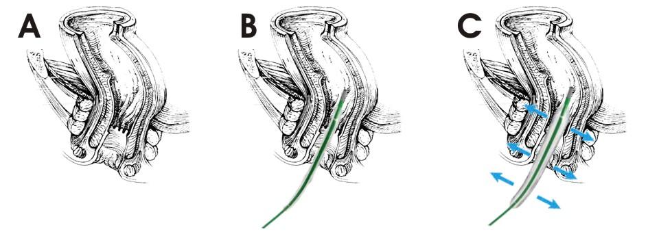 trattamento ragade anale -