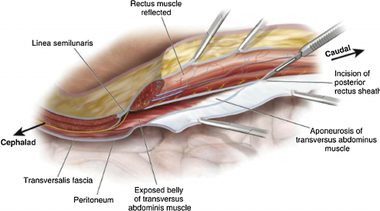 Riparazione laparocele - ricostruzione parete addominali