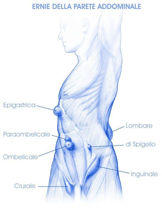 ernie parete addominale - ernia inguinale - ernie inguinali - ernia ombelicale - ernie ombelicali - ernie addominali - laparocele - ernia incisione - diastasi muscoli retti addominali - ernia epigastrica - ernia di spigelio - ernia crurale