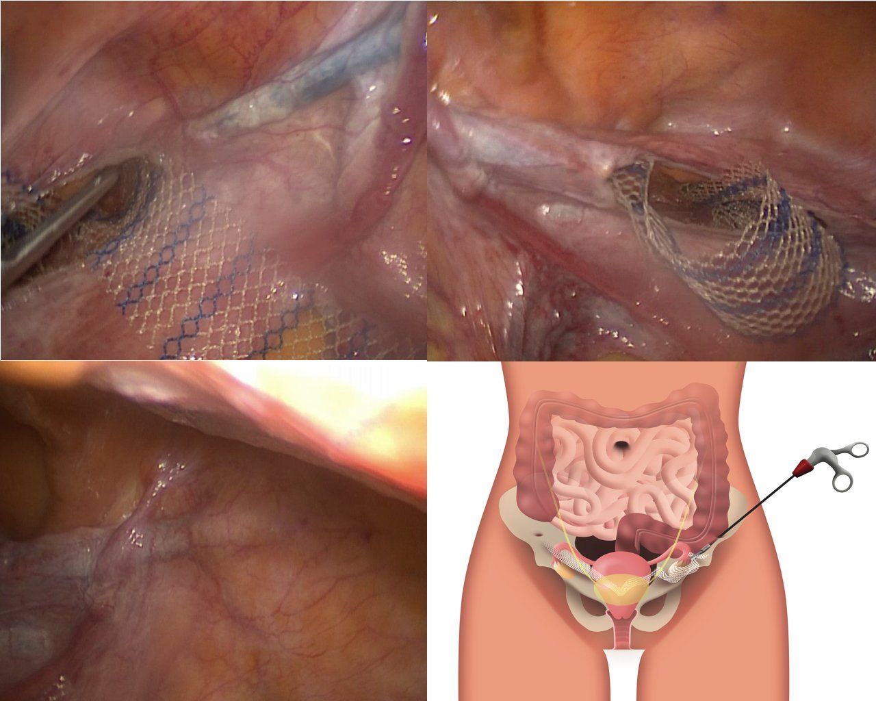 Sospensione degli organi pelvici laparoscopica