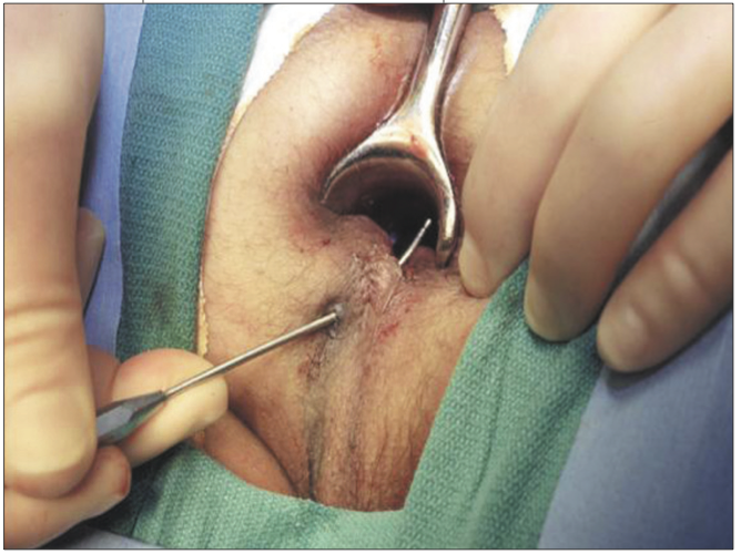 Trattamento fistola perianale con cellule staminali