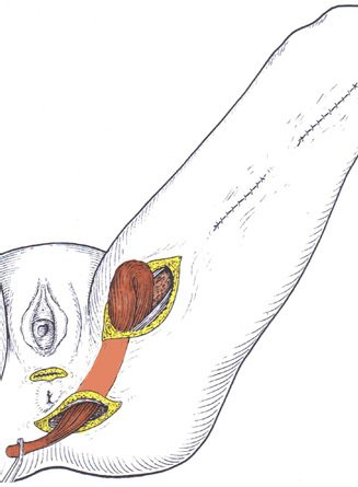 trattamento incontinenza fecale