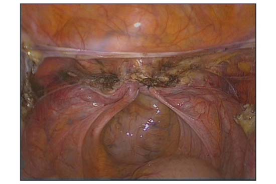 chirurgia ginecologica