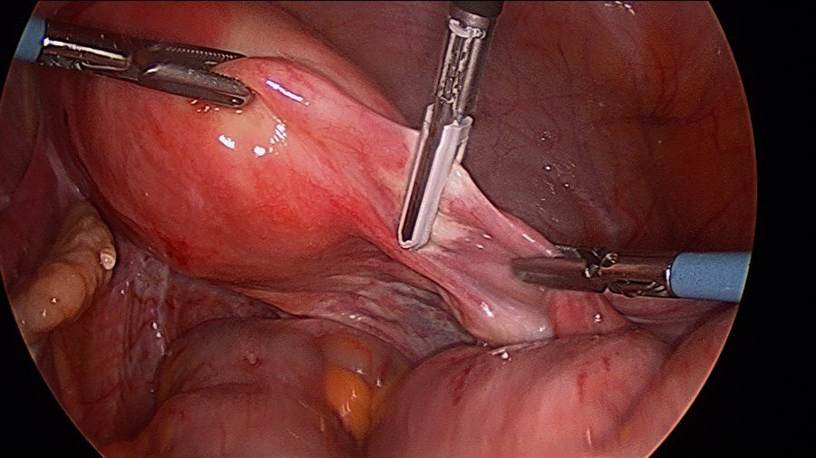 chirurgia ginecologica