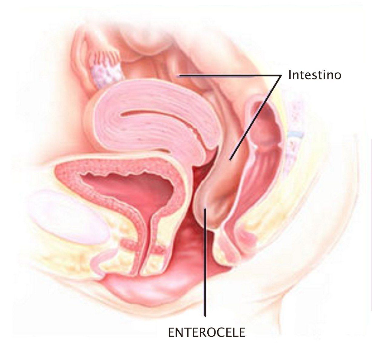 enterocele - peritoneocele