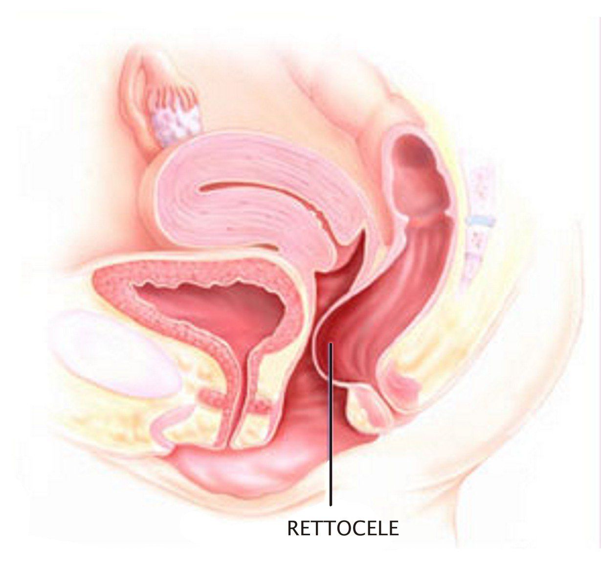 rettocele