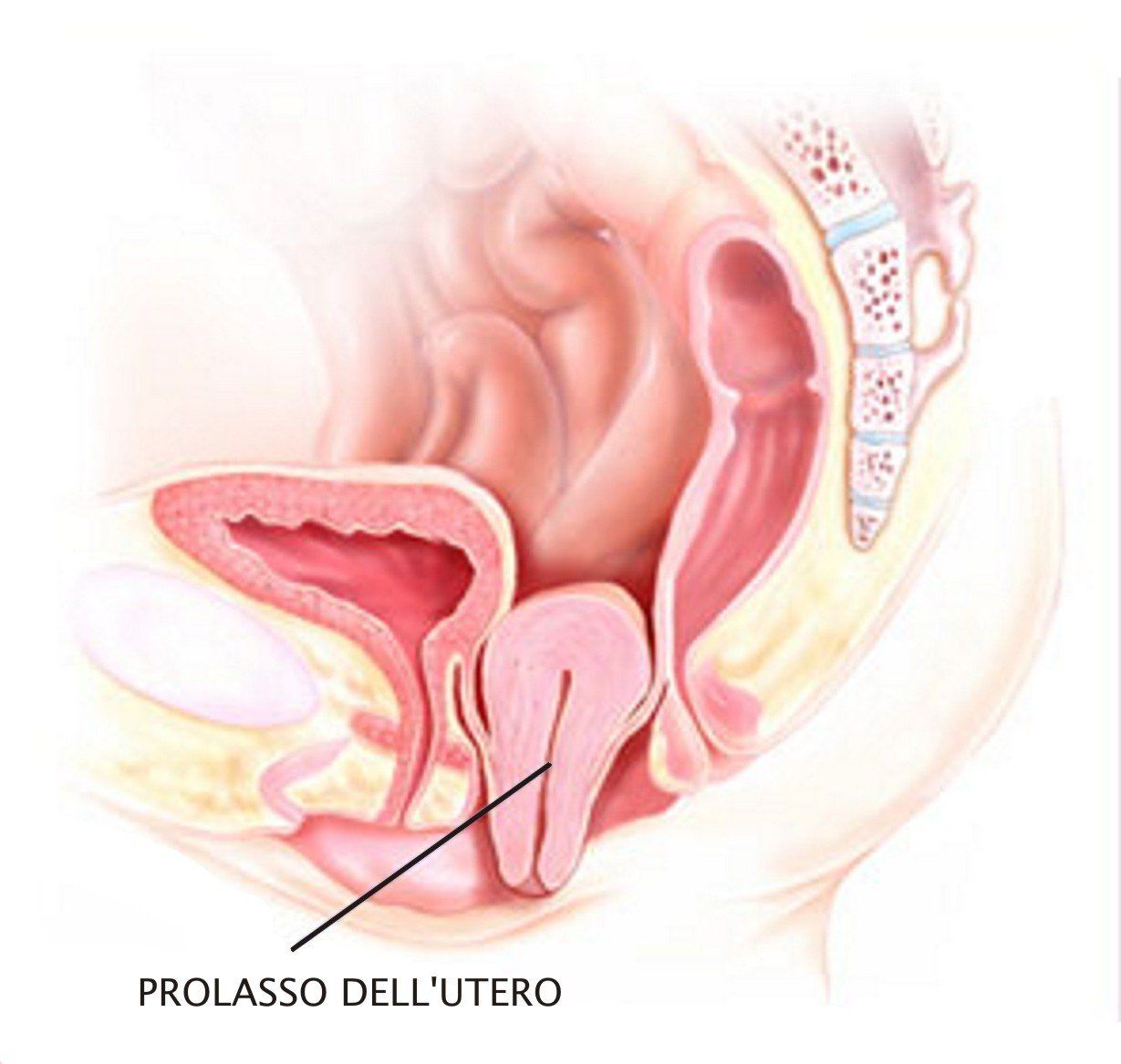 prolasso utero - isterocele - procidenza
