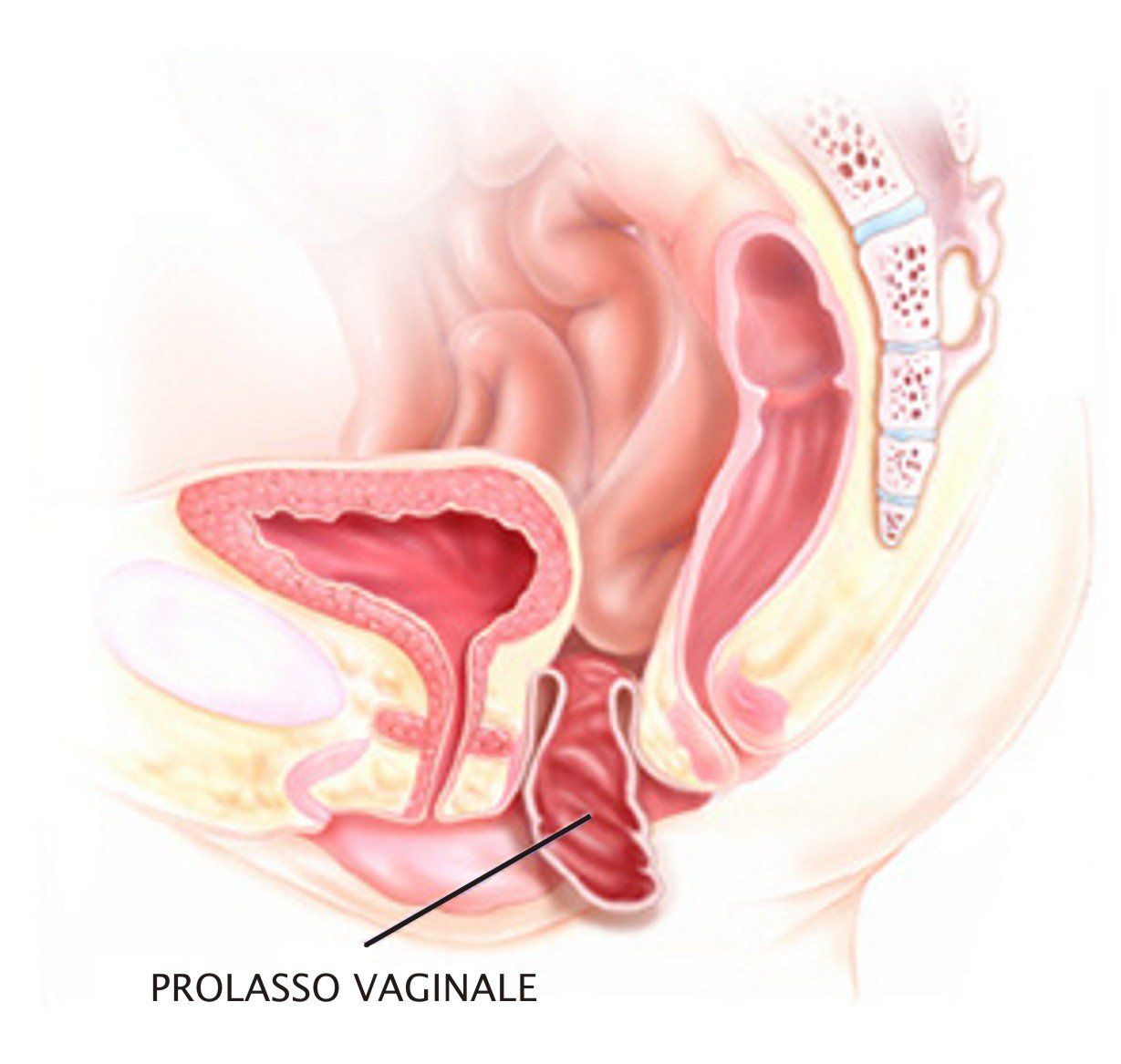 colpocele - prolasso vaginale