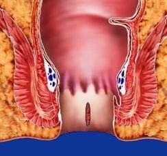 malattia emorroidaria - emorroidi - prolasso emorroidario - prolasso muco emorroidario - trombosi emorroidaria - varicosi emorroidaria - sanguinolento retto - sanguinolento ano - dolore ano - prurito ano