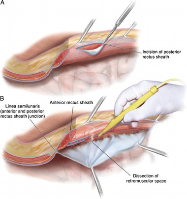 Riparazione laparocele - ricostruzione parete addominali