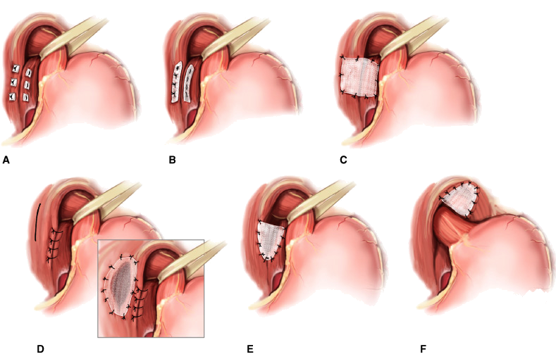 prolassectomia con stapler - chirurgia emorroidi - tecnica di Longo - resezione prolasso emorroidario