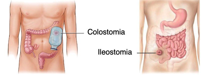 Colostomia e ileostomia