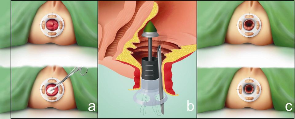 resezione tranasanale del retto - prolassectomia con stapler - chirurgia emorroidi - tecnica di Longo - resezione prolasso emorroidario