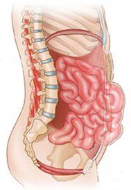 Riparazione laparocele - ricostruzione parete addominali