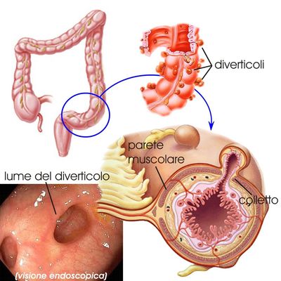 Malattia diverticolare - Diverticolite