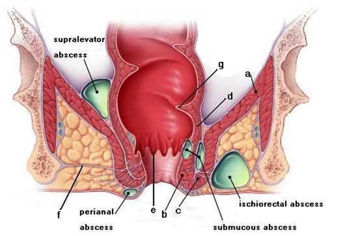 malattia emorroidaria - emorroidi - prolasso emorroidario - prolasso muco emorroidario - trombosi emorroidaria - varicosi emorroidaria - sanguinolento retto - sanguinolento ano - dolore ano - prurito ano