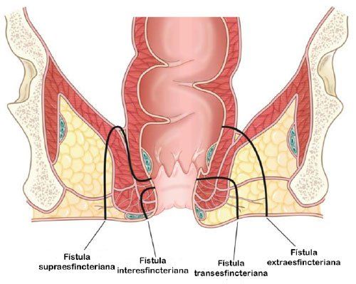 ascesso e fistola perianale
