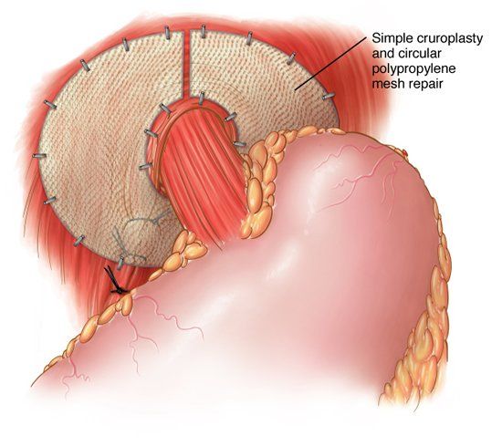 prolassectomia con stapler - chirurgia emorroidi - tecnica di Longo - resezione prolasso emorroidario