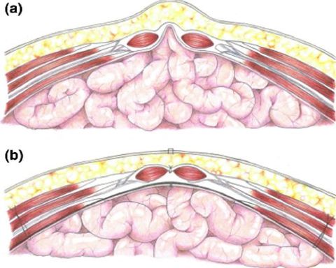 Riparazione laparocele