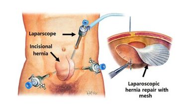 Riparazione laparocele laparoscopica
