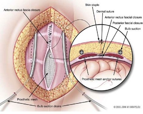 Riparazione laparocele - ricostruzione parete addominali