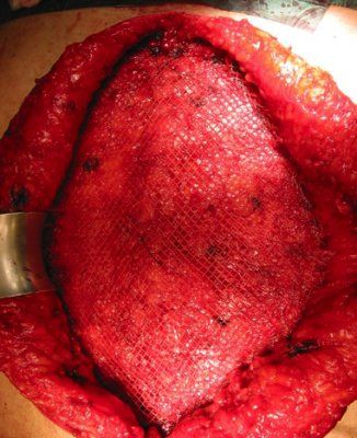 Riparazione laparocele - ricostruzione parete addominali