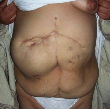 Riparazione laparocele - laparocele voluminoso